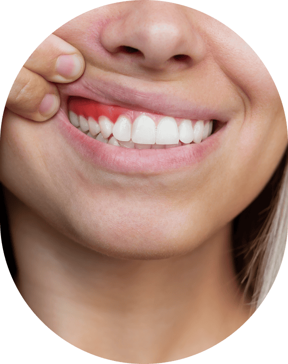How Does Gum Disease Happen
