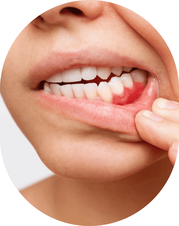 Signs You Have Gum Disease