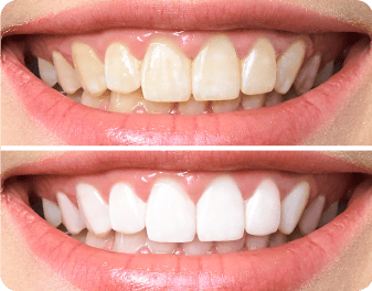 teeth whitening