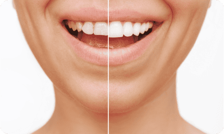 veneers